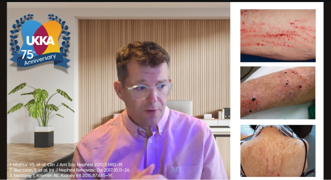 Prof Jim Burton presents this course on CKD Itch (pruritus)